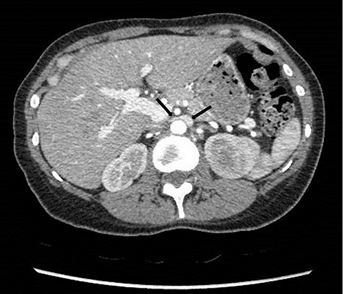 Computed tomography angiogram on presentation showing pre-compressed LRV (right arrow); and compressed LRV (left arrow).