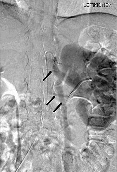 Renal angiography showing thin trickle of contrast passing through the LRV into the inferior vena cava (IVC) (top arrow), paraspinal collateral (middle arrow) and retrograde reflux of contrast into left ovarian vein (bottom arrow).