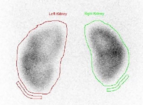 DMSA scan on presentation showing symmetrical bilateral uptake of the radioisotope with slight enlargement of the left kidney with patchy uptake in the renal cortex.
