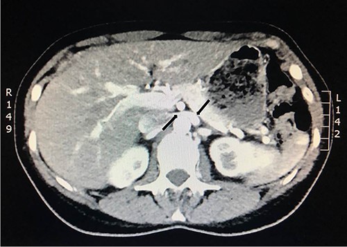 Computed tomography angiogram 6 months later showing pre-compressed LRV (right arrow); and compressed LRV (left arrow), but resolution of the congestion and swelling of the left kidney.