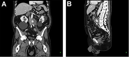 CT aortic angiography demonstrating a 47 × 46 × 47 mm infrarenal aortic pseudoaneurysm with an area of contrast filling and associated mass displacement of the aorta and inferior vena cava. (A) Coronal and (B) sagittal.
