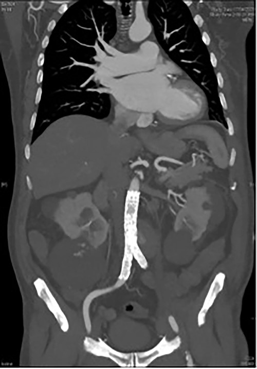 CT angiography post endovascular repair demonstrates an aorto-bi-iliac stent graft extending from the infrarenal aorta to the common iliac arteries with a small area of persistent filling of the pseudoaneurysm that subsequently resolved.