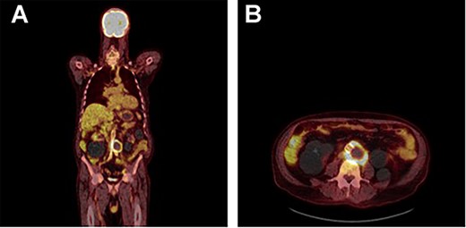 FDG PET/CT study demonstrating a rind of intense FDG uptake (SUV max 13.4) along the circumference of the lateral lower aortic aneurysm abutting the prosthesis however demonstrating no uptake tracking along the prosthesis. No other areas of FDG activity were demonstrated. (A) Coronal and (B) axial.