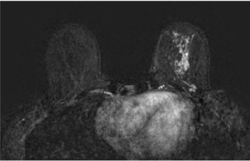 Axial fat-saturated post contrast Magnetic Resonance Imaging (MRI) of the breasts. There is extensive stippled non mass like enhancement throughout the inferior and central left breast with type 1 benign kinetics in keeping with DCIS.