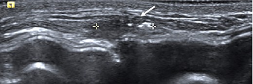 Ultrasound of the left central breast identified an irregular mass on the capsule of the implant with a focus of hyperechoic calcification (arrow).