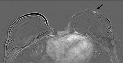 Axial post contrast fat-saturated sequence identified bilateral implants and an 11 mm oval foci of type 1 enhancement in the site of clinical concern on the capsule (black arrow).