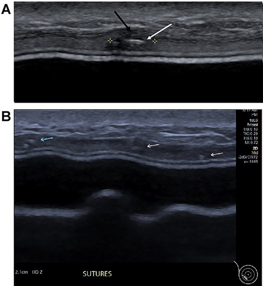 (A) Magnified ultrasound image identified a 5 mm hypoechoic focus of thickening within the capsule (black arrow and area between the cursers) with two parallel lines centrally within the focus which represents the suture (white arrow). (B). The ultrasound demonstrates the equally placed sutures identified as small white parallel lines (arrows) across the ADM.