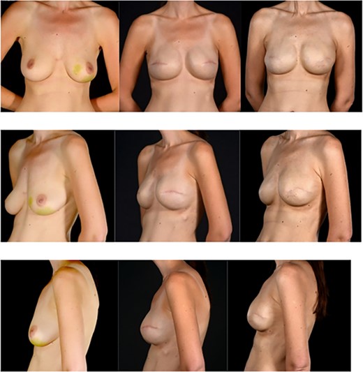 Pre and post photographs showing the preservation of reconstructed breast volume and shape despite the wide local excision of a recurrence and the peri-implant capsule shape despite the wide local excision of a recurrence and the peri-implant capsule. (A) (first column of images) images are pre-mastectomy, (B) column images are 4 years later prior to WLE and (C) column images are after WLE of the recurrence and reconstruction of the capsule deficit with a surgimend ADM patch. Note the maintenance of the shape and size of the breast.