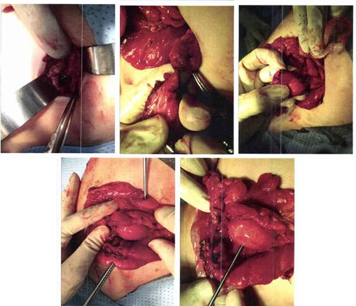 Excisional laparotomy, the area of the transverse colon as noted is inflamed and covered with necrotic part, below it a mesocolon cyst was noted too.