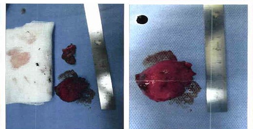Excised cyst containing dark fluid assumed to be blood, it measured 3 cm by 2.5 cm, and sample was sent for histopathology to confirm diagnosis.