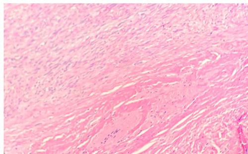 Microscopic examination reveals long sweeping fascicles with uniform elongated, slender, spindled cells with pale cytoplasm in a collagenous stroma (left upper- desmoid-type fibromatosis). Sheets of uniform epithelioid cells with abundant eosinophilic granular cytoplasm and small nuclei (right lower-granular cell tumor) (H&E 10x).