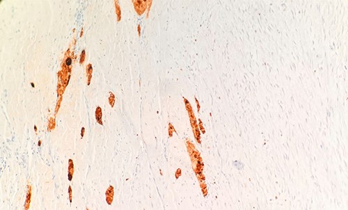 Microscopic examination reveals tumor cells are positive for S100. IHC 20X.