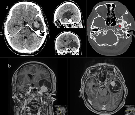 Imaging characteristics of the V3 lesion. (a) CT scan axial, sagittal and coronal views (brain and bone window) showing the lesion in the left middle fossa with enlargement of the foramen ovale (asterix). The lesion (arrow) is uniformly enhancing with a large capping cyst causing mass effect. (b) MRI scan coronal and axial views showing a mixed solid and cystic lesion (arrow) in proximity to the Meckel’s cave.