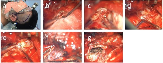 Surgical technique. (a) Skin incision; (b) drilling of the lesser wing of the left sphenoid bone; (c) incision of the meningo-orbital band, (d) dura propria and periosteal dura at the superior orbital fissure, (e) dura propria and periosteal dura at the foramen rotundum, (f) tumor coming into view at the foramen ovale, (g) visualization of the foramen ovale from intradurally after tumor debulking.