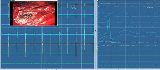 Electromyography of trigeminal nerve (motor). Trigger EMG of the motor branches of the trigeminal nerve with positive motor responses (mentalis muscle EMG). Nearby cranial nerves were additionally monitored including the facial nerve CN VII (orbicularis oculi, orbicularis oris and mentalis muscle) and abducens nerve CN IV (lateral rectus muscle).