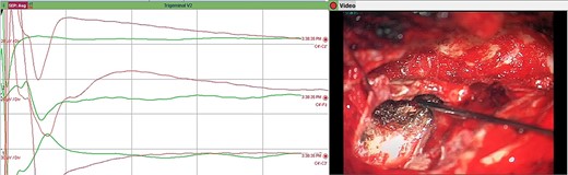 Direct nerve stimulation of the sensory V2. Direct nerve stimulation of the sensory branch V2 at the foramen ovale demonstrating cortical SSEPs recorded from scalp electrodes (montages C4’-Cz’, C4’-Fz, C4’-C3’) accordingly to the international 10–20 EEG system. Average latency: 5.4 ms, amplitude: 12.5 μV.