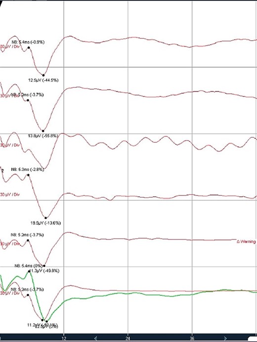 Trigeminal V2 SSEP recordings. Trigeminal V2 SSEPs were continuously recorded on the scalp using the montage C4’-Fz. Average latency: 5.4 ms, amplitude: 13 μV.