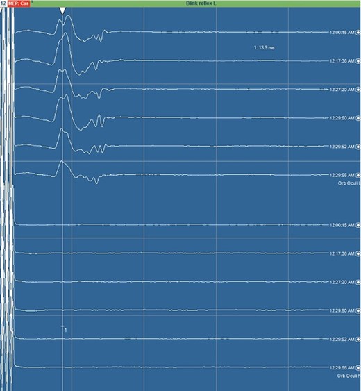 Blink reflex. Blink reflex from left side stimulation of the supraorbital branch of the trigeminal nerve was observed with EMG activity from left orbicularis oculi muscle. Both early response (R1) and late reflex activity (R2) were recorded throughout the surgical procedure.