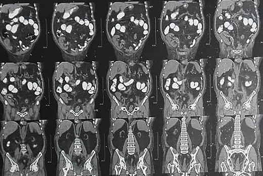 Preoperative CT scan shows mild-to-moderate hydronephrosis in transplanted kidney and two atrophic native kidneys.