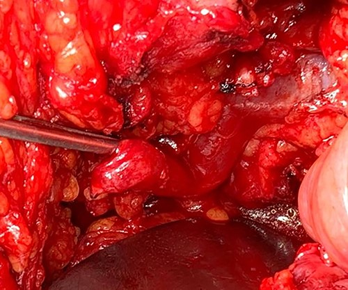 Dilated graft ureter was dissected gently from dense fibrosis.