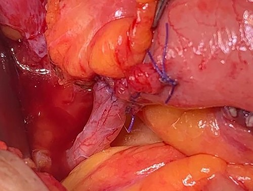 The graft ureter was reimplanted to the ascending loop of the pouch with end-to-end anastomosis.