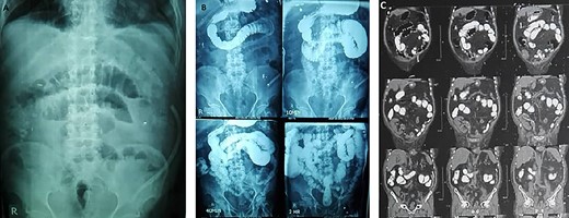 Post-operative ileus is obvious in KUB (A), fluroscopic barium study (B) and abdomino-pelvic CT scan with oral contrast (C).