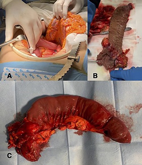(A) Intra-operative image of duodenojejunal junction neoplasm; (B and C) histopatological examination.