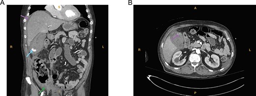 (A) Computed tomography imaging from Case 1 showing a distended gallbladder with multiple calculi (cyan arrow) as well as hyperdense intraluminal fluid (magenta arrow) with collection in the pelvis (green arrow) consistent with hemorrhage. Present in the figure, the letters S, L, I and R denote superior, left, inferior and right, respectively. (B) Computed tomography imaging from Case 1 showing the tortuous path of a cholecystic artery branch (magenta arrow) at the gallbladder fundus. Present in the figure, the letters A, L, P and R denote anterior, left, posterior and right, respectively.