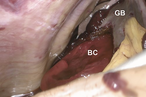 Intraoperative laparoscopic image showing the protrusion of a bright red clot (BC) from a perforation of the gallbladder (GB) wall upon cephalad retraction of the gallbladder.
