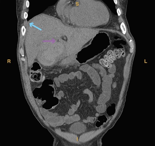 Computed tomography imaging from Case 2 showing air in the gallbladder wall (magenta arrow) as well as intraluminal fluid (cyan arrow) consistent with hemorrhage. Present in the figure, the letters S, L, I and R denote superior, left, inferior and right, respectively.