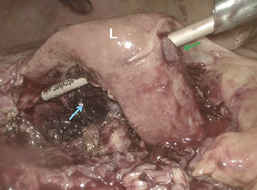 Intraoperative laparoscopic image showing obliteration of segment 5 (cyan arrow) of the liver (L) with perforation into segment 4B (green arrow).