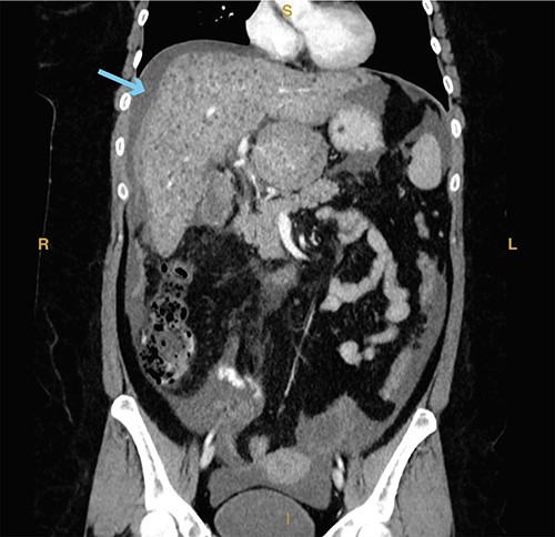 Computed tomography imaging from Case 3 showing significant hemoperitoneum (cyan arrow). Present in the figure, the letters S, L, I and R denote superior, left, inferior and right respectively.