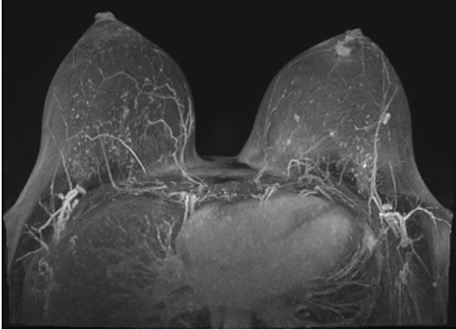 MRI of breasts showing left retro-areolar lesion.