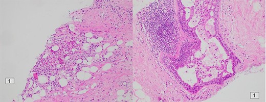 Histology of the patient’s left retro-areolar lesion.