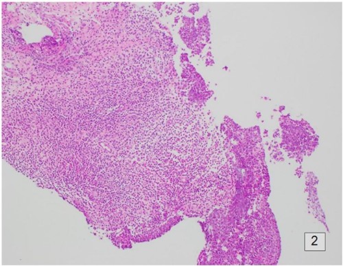 Histology of the surrounding breast tissue adjacent to the left retro-areolar complex.