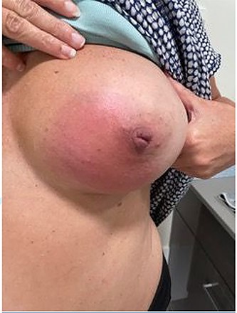 Photo of patients left breast.