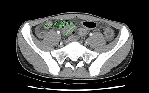 The region of phlegmon in the adjacent ileal mesentery, measuring about 29 × 32 mm.