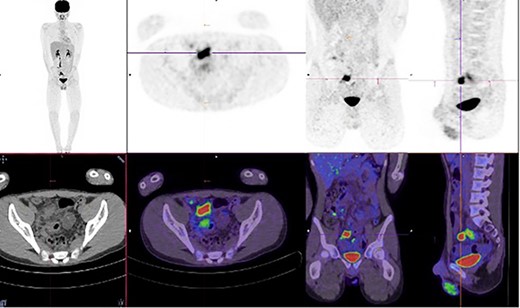 Increased metabolic activity in the terminal ileum and anterior to the rectosigmoid junction to the right of midline.