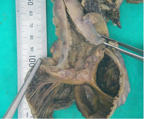 Cut open ileocaecal specimen showing thickened, oedematous and inflamed intestinal wall.
