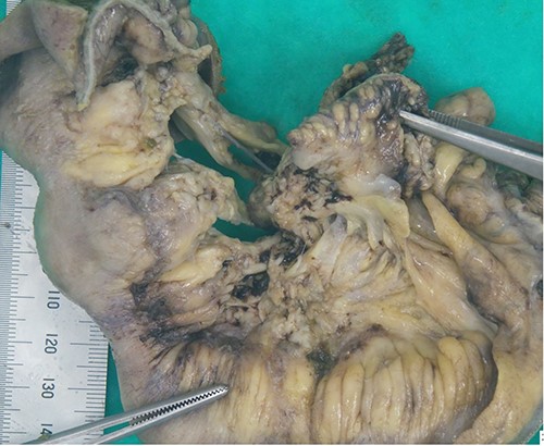 Ileocaecal resection specimen showing inflammatory phlegmon secondary to perforation arising from the terminal ileum.