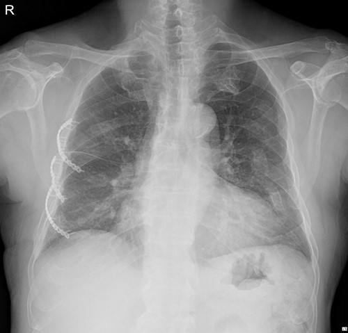 Chest X-ray on discharge day after SSRF (11 December 2021).
