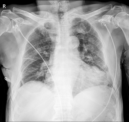 Immediate postoperative chest X-ray after plates removal (24 February 2022).