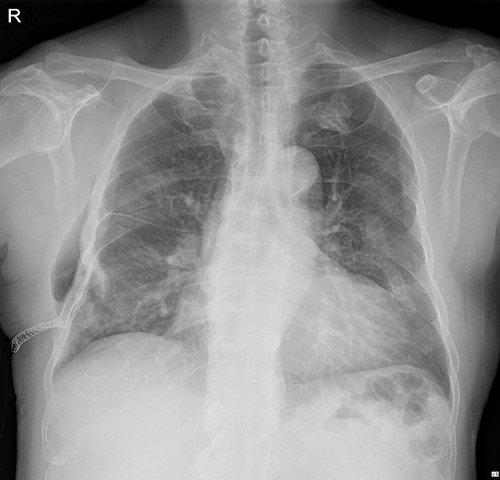 Chest X-ray on the first outpatient clinic (07 March 2022).