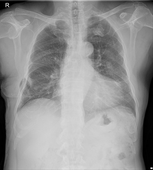 Chest X-ray after applying a 10 FR drainage thoracic catheter into the submuscular layer (11 March 2022).