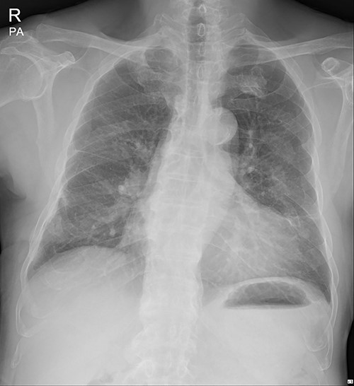 Disappeared submuscular pneumothorax (16 March 2022).
