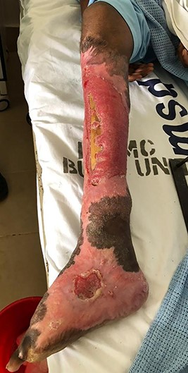 Post amputation of big and second toes and post trephination, exposed tibia.