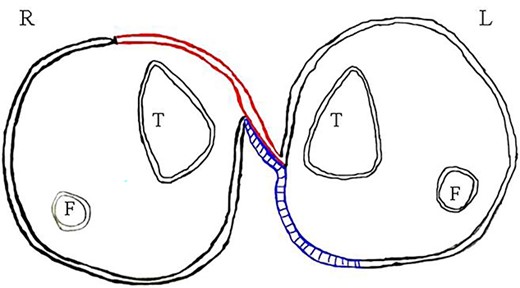 Diagrammatic representation (L-left, R-right, T-tibia, F-fibula, red-flap and blue-grafted area).