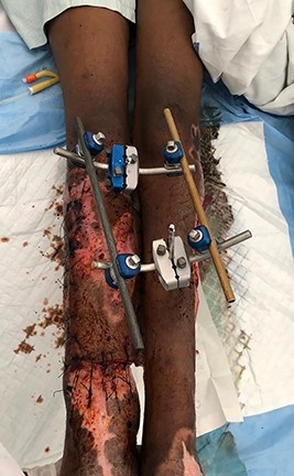 Post cross-leg flap with external-fixator for immobilization of both lower limbs.