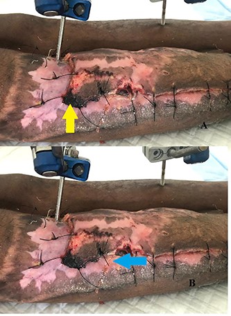 (A) Flap edge necrosis (yellow arrow) (B) pus discharge (blue arrow).