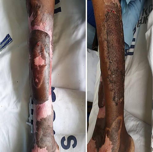 Post flap release and grafting of donor site.